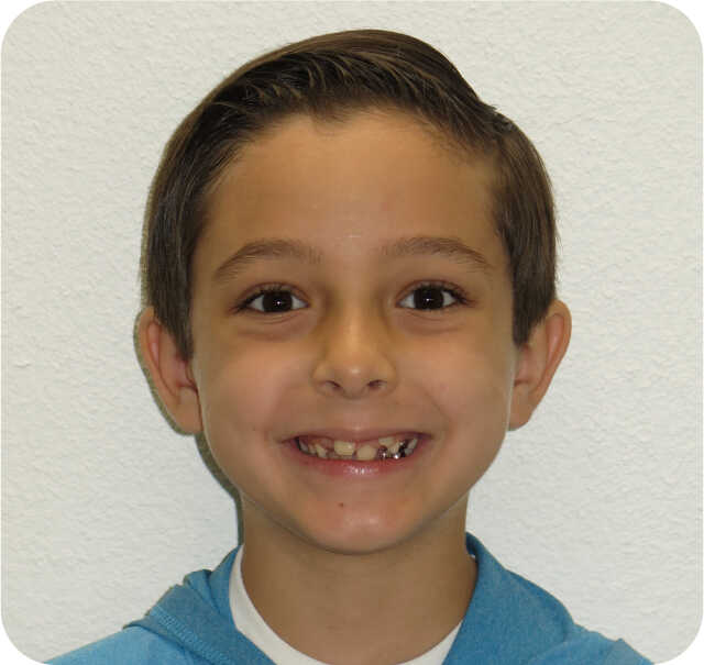 Another Before Early Orthodontics in San Antonio, TX