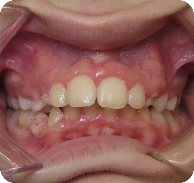 Close up of After Early Orthodontics in San Antonio, TX