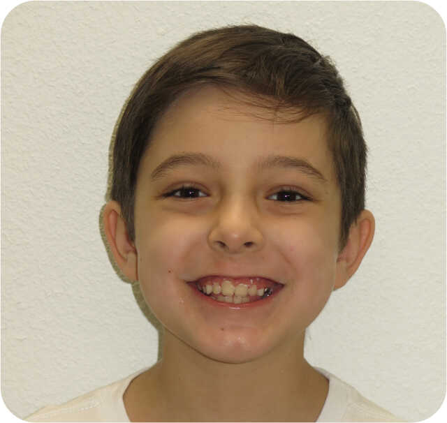 Another After Orthodontics in San Antonio, TX