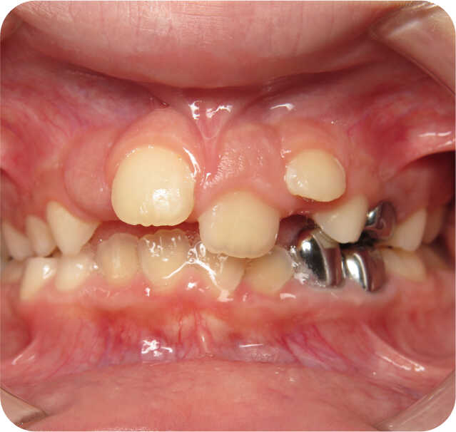 Close up of Before Orthodontics in San Antonio, TX